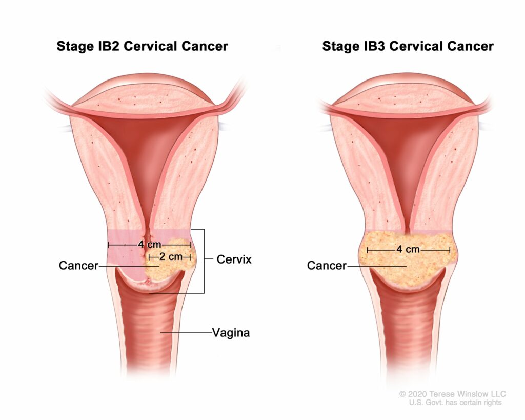 kanser cervic